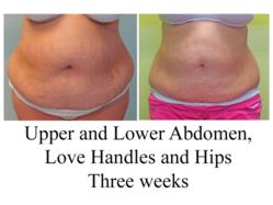 liposuction volume lipo after abdomen lower before smart skin handles fat tummy big liters tuck results upper hips laser abdominal